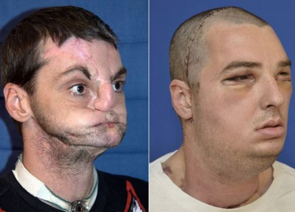 Transplantacija lica