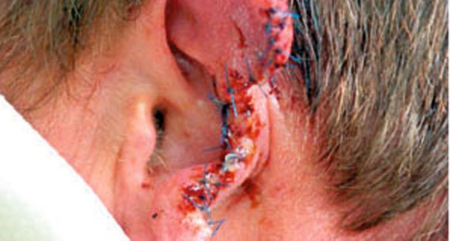 odgrizeno uho1 odgrizeno uho1