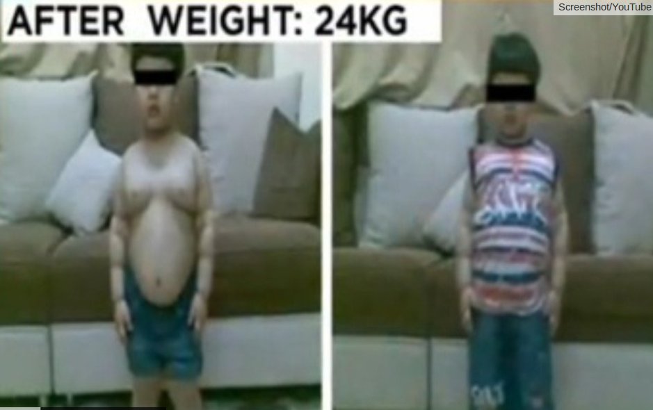 dječak imao operaciju smanjenja želuca dječak imao operaciju smanjenja želuca