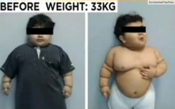 dječak imao operaciju smanjenja želuca dječak imao operaciju smanjenja želuca