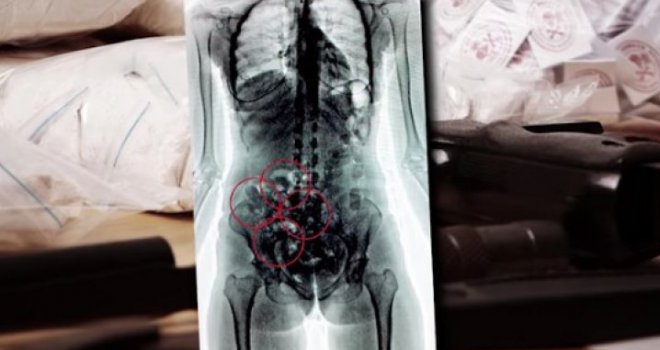 Pogledajte šta se sve krijumčari u tjelesnim otvorima: Prenosili i do 30 stvari naguranih u anus