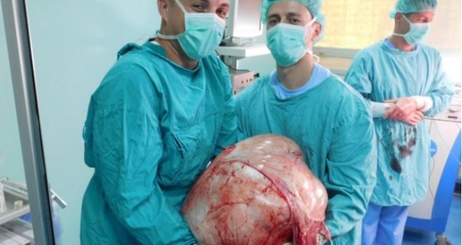 Nesvakidašnji prizor na hirurgiji UKC RS: Operisan tumor težine 31,3 kg