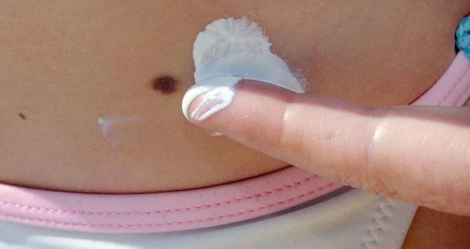 Uprkos efikasnom lijeku, metastatski melanom 'smrtna presuda' za oboljele u FBiH