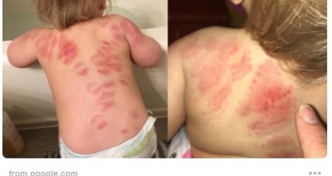 Mozak mi je prestao raditi... Bože, jesu li to sve ugrizi?! Majka se šokirala kada je skinula kćerku nakon vrtića!