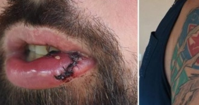 Pretukli ga na plaži u Baškoj Vodi: Napali ga s leđa, oborili udarcem u potiljak, a onda je počela strahota...