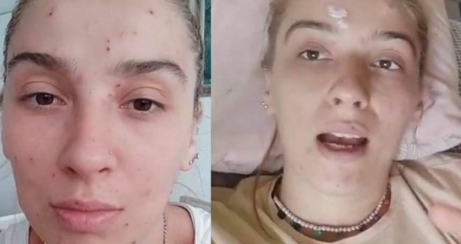 'Preko noći sam osjetila da me svrbi glava i da imam neke čireve': Džejnu u Neumu po cijelom tijelu izboli komarci, dobila strašnu alergiju