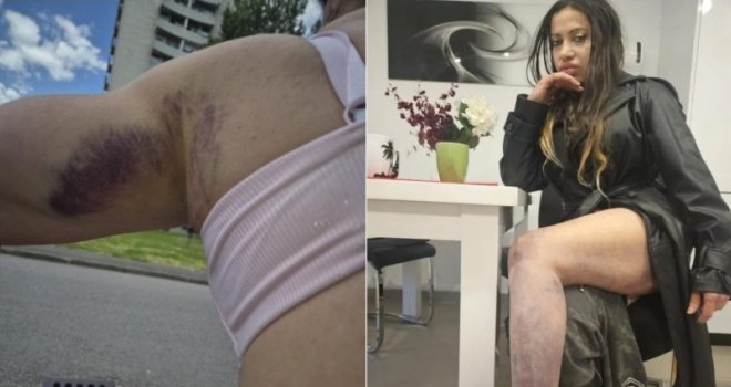 Pjevačica Super Silva opet brutalno pretučena: 'Teror istih ljudi traje već 15 godina... Što ih više prijavljujem, to su gori!